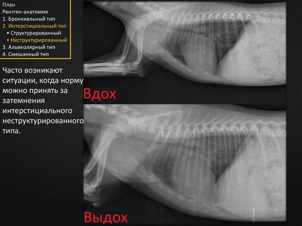 Анатомия рентген. Затемнения интерстициального неструктурированного типа. Рентгенологическая анатомия. Затемнения бронхиального типа. Затемнения альвеолярного типа на рентгене.