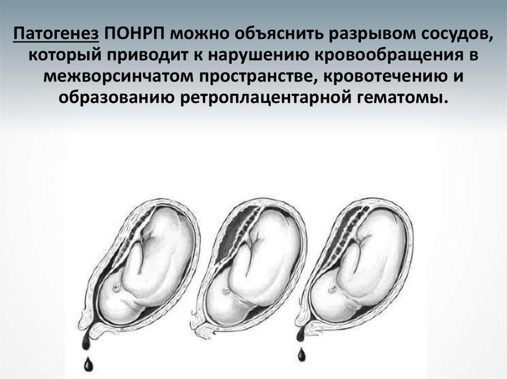 Отслойка при беременности. Преждевременная отслойка нормально расположенной плаценты (ПОНРП). ПОНРП ретроплацентарная гематома. Отслойка нормально расположенной плаценты патогенез. Нормальная плацента предлежание и отслойка.