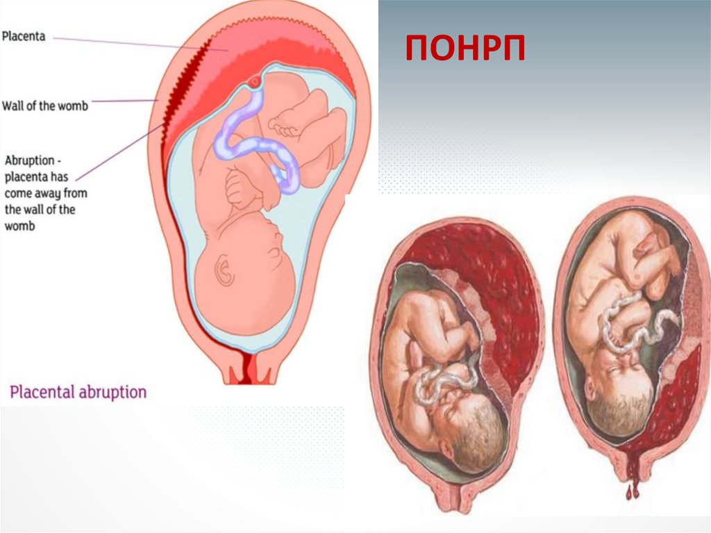 Преждевременная отслойка плаценты презентация