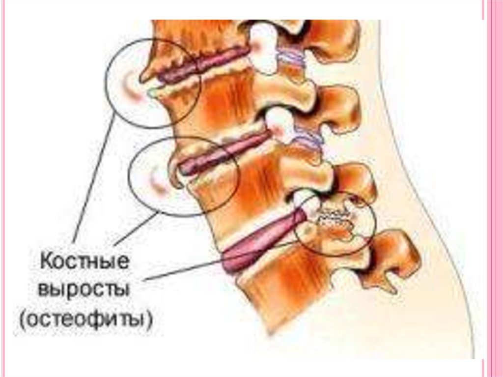 Краевые остеофиты тел позвонков что это такое фото