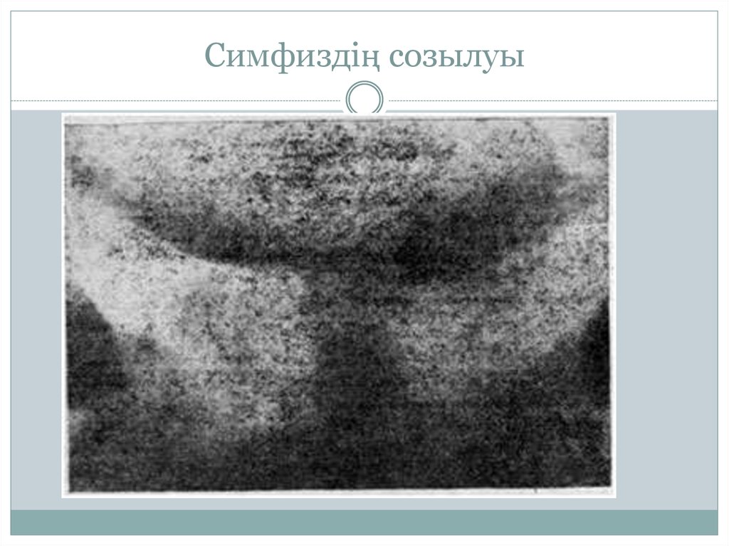 Симфиздің созылуы