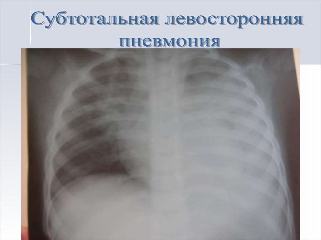 Левосторонняя пневмония. Субтотальная левосторонняя пневмония. Субрактильная пневмония. Двусторонняя субтотальная пневмония. Субтотальная пневмония рентген.