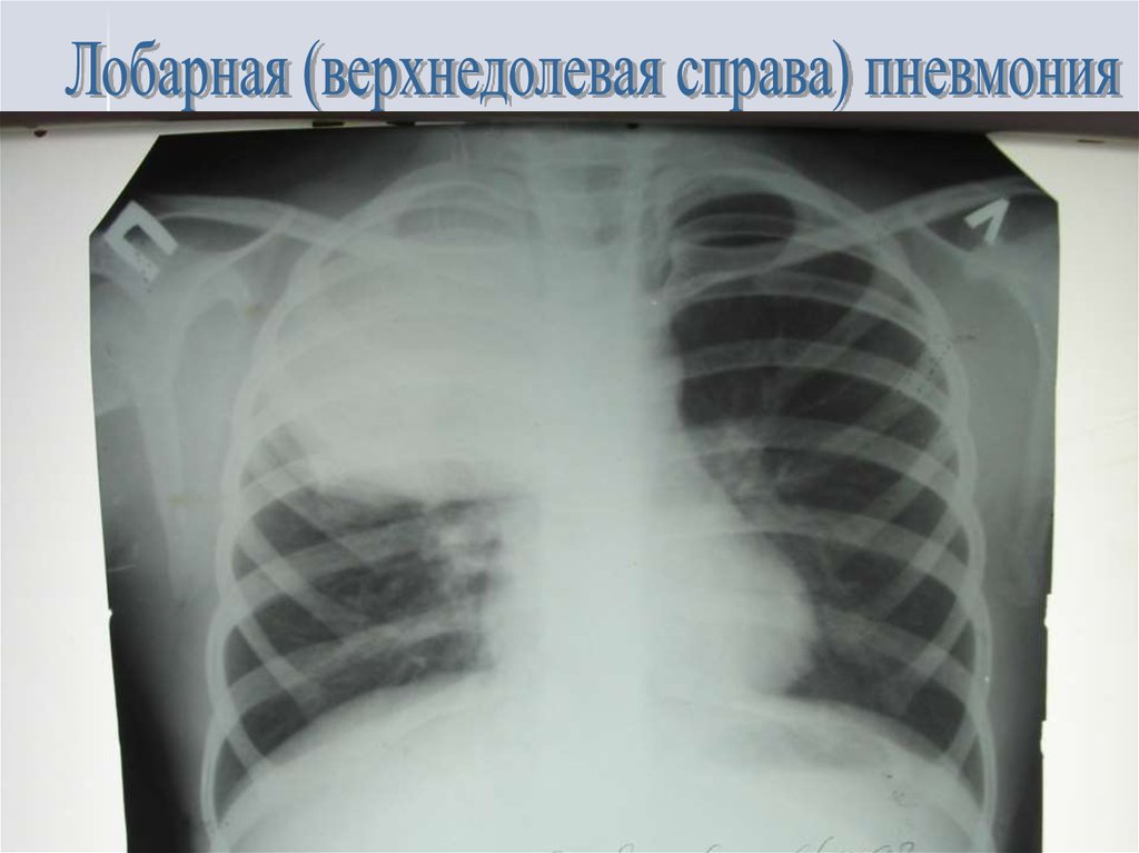 Правосторонняя пневмония у ребенка. Рентген верхнедолевой пневмонии. Лобарная пневмония рентген. Левосторонняя верхнедолевая пневмония рентген. Правосторонняя верхнедолевая пневмония на рентгене.