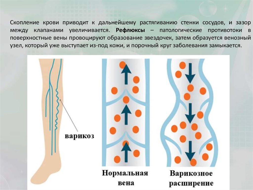 Тромбофлебит смп. Варикозное расширение вен. Варикозное расширение вен нижних конечностей. Варикозное расширение вен 4 степени. Варикозная болезнь нижних конечностей.