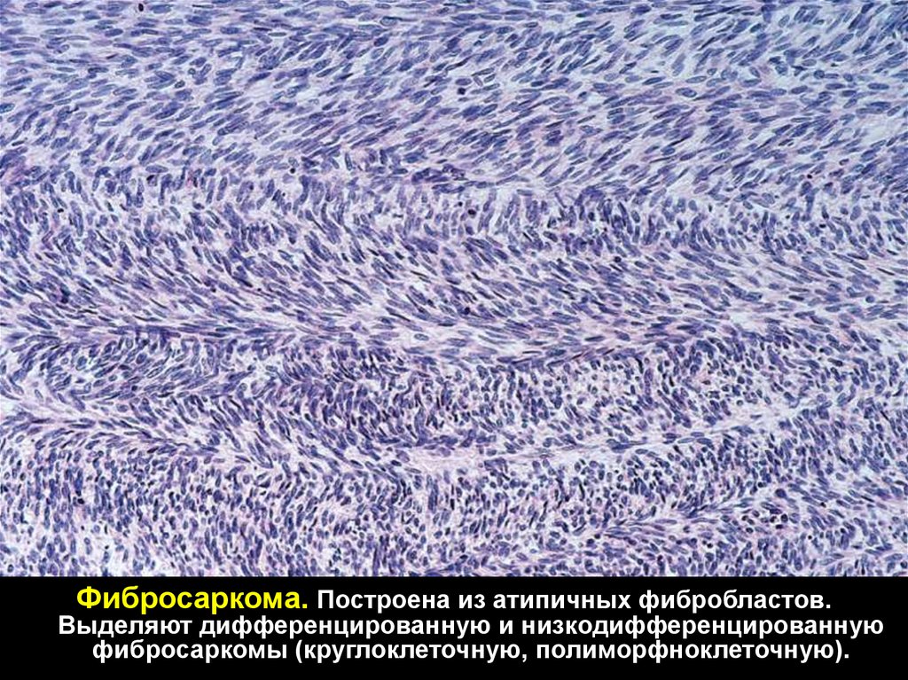 Фибросаркома. Дифференцированная фибросаркома. Низкодифференциальная фибросаркома низкодифференцированная. Исход низкодифференцированного фибросаркома.