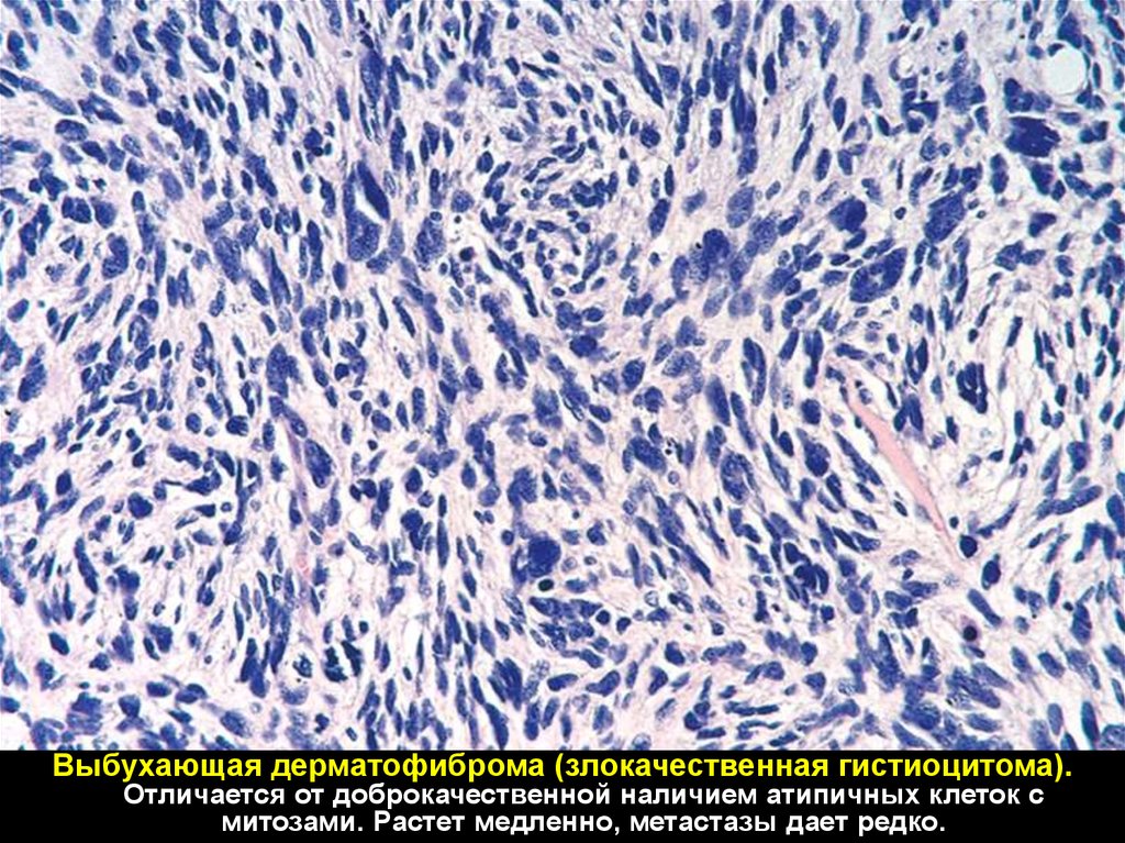Мезенхимальные опухоли патанатомия презентация