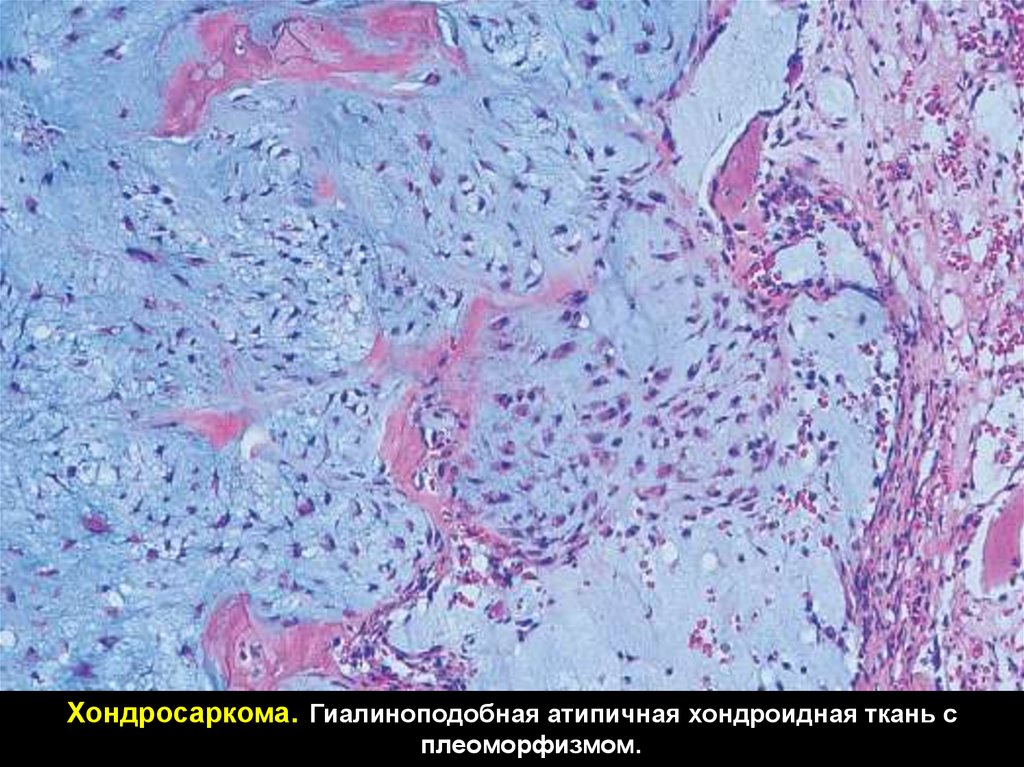 Мезенхимальные опухоли. Хондроидная Сирингома гистология. Мезенхимальная хондросаркома. Хондросаркома цитология.