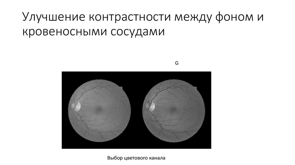 Улучшение контрастности между фоном и кровеносными сосудами