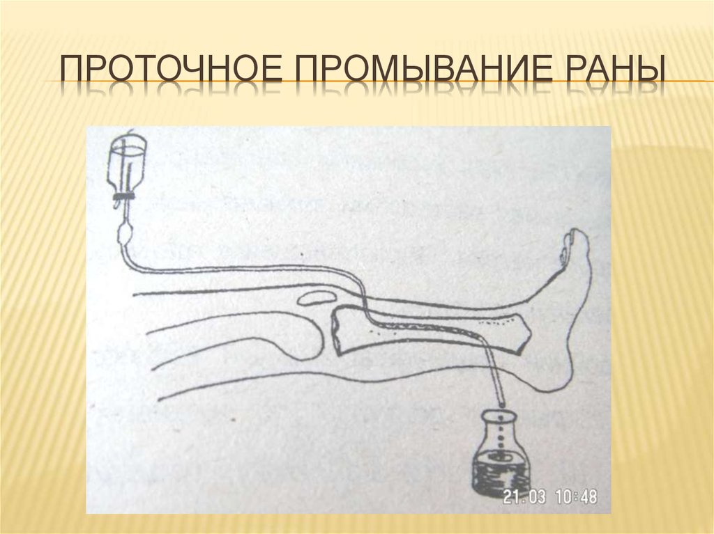 Промывание. Промывание раны пульсирующей струей. Проточно-аспирационное промывание.