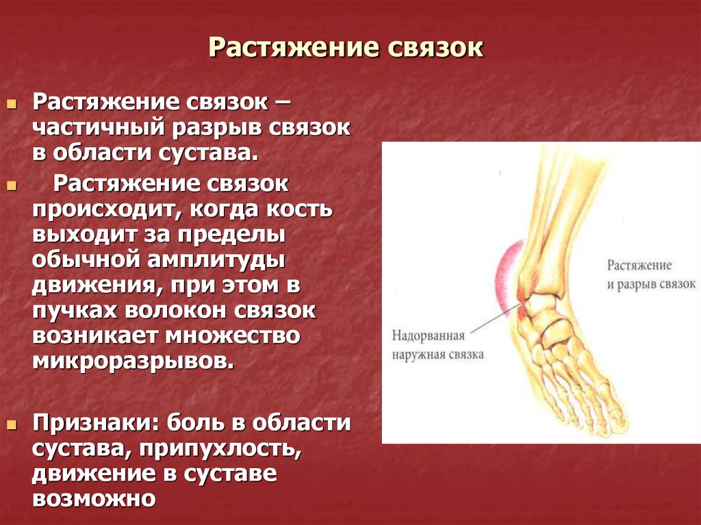 Вывих сустава закрытый перелом разрыв сухожилия. Растяжение связоксвязок. Растяжения, повреждения связок..