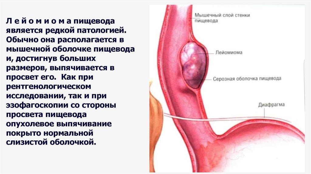 Зно пищевода карта вызова