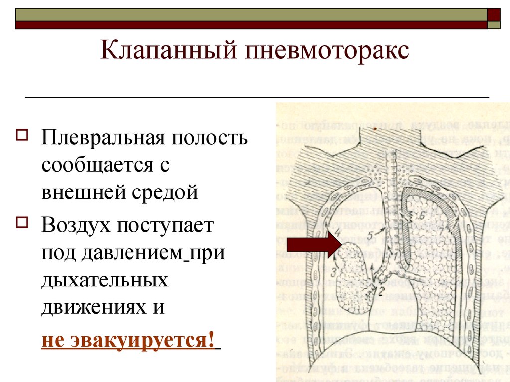 Клапанный пневмоторакс. Наружный клапанный пневмоторакс. Клапанный пневмоторакс механизм развития. Клапанный пневматорок. Напряженный клапанный пневмоторакс.