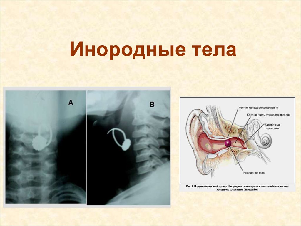 Инородное тело слухового прохода карта вызова смп