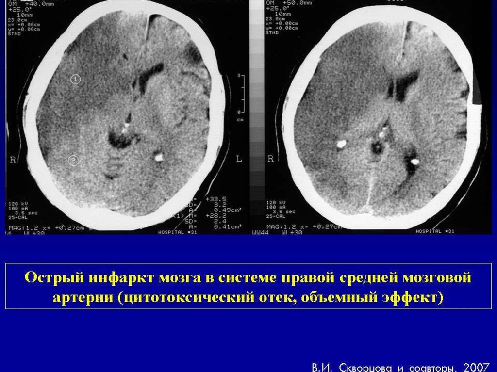 Обширный инсульт. Цитотоксический отек головного мозга. Кт ишемия ГМ. Полушарный ишемический инсульт кт. Цитотоксический отек головного мозга кт.