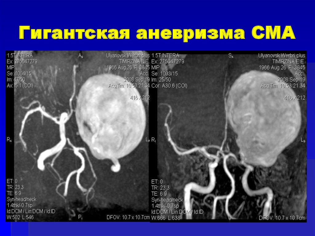 Мешотчатые аневризмы вса. Аневризма сегмента м1 левой СМА. Аневризма СМА на кт. Мешотчатая аневризма мрт.