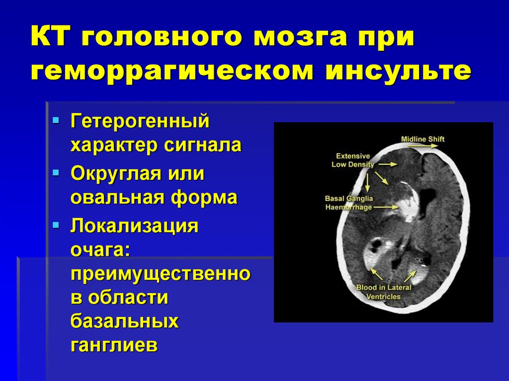 Геморрагический инсульт на кт фото