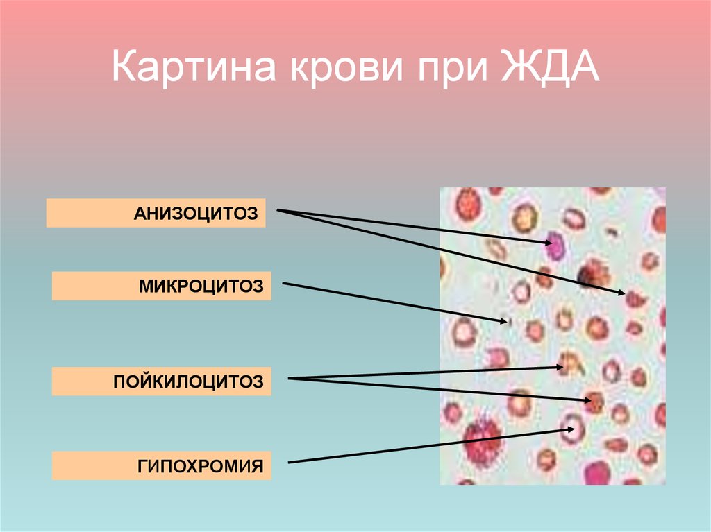 Картина периферической крови при железодефицитной анемии