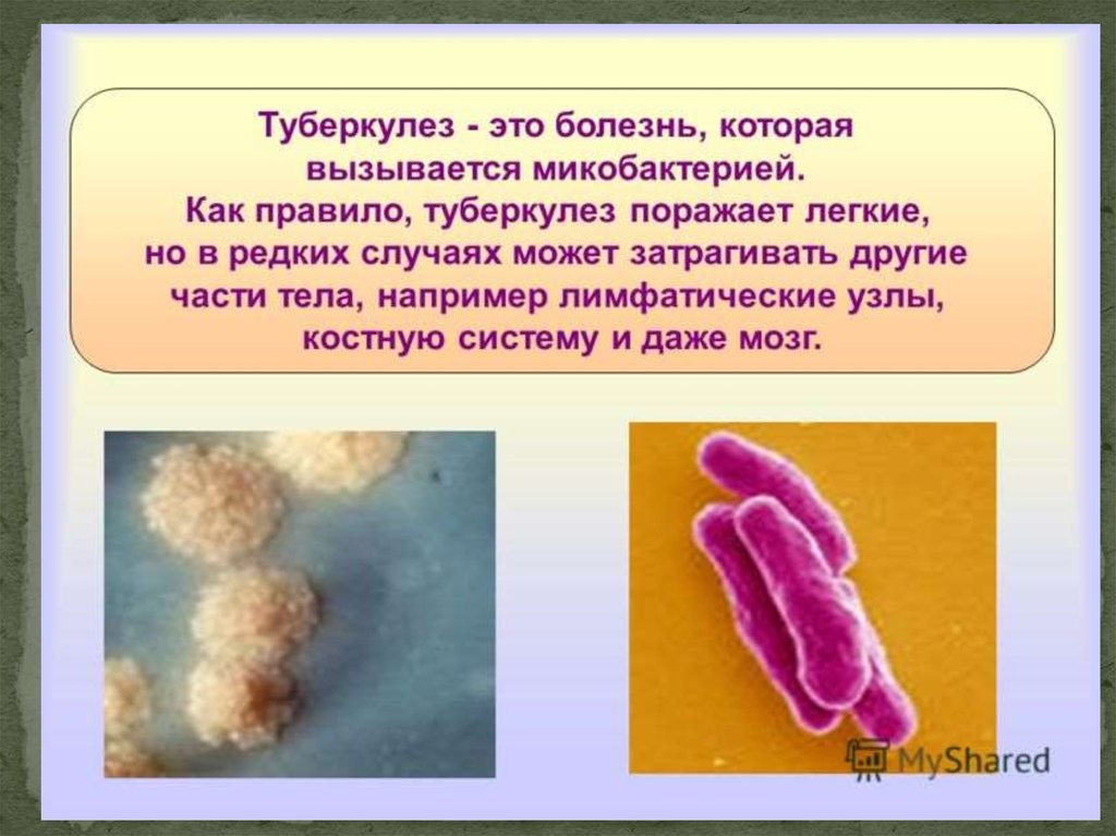 Туберкулез 5 класс