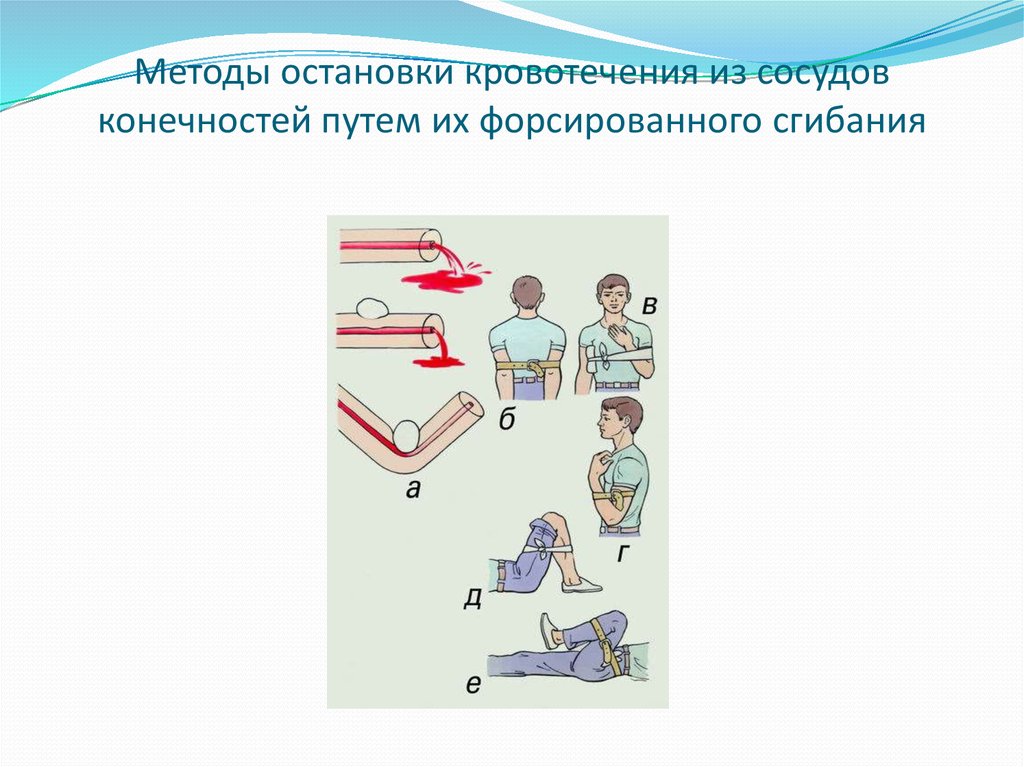 Способ остановки кровотечения конечности. Форсированное сгибание конечности. Метод остановки кровотечения путем сгибания конечности. Методы остановки кровотечения из сосудов конечностей путем их. Способы остановки кровотечений при травме конечностей.