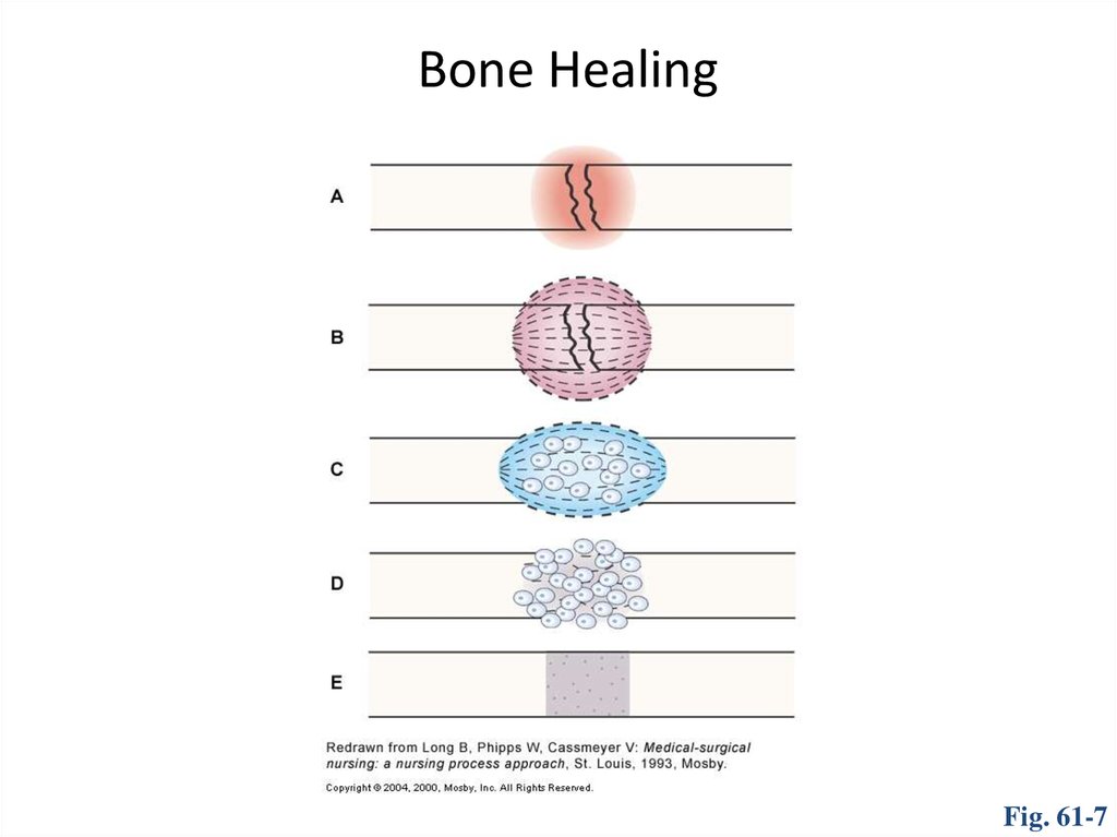 Bone healing