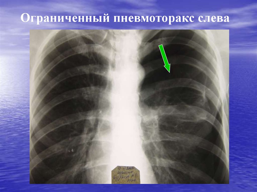 Рентген картина пневмоторакса