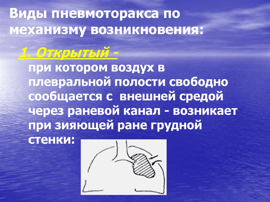 Полость свободно. Пневмоторакс механизм. Пневмоторакс механизм возникновения. Виды пневмоторакса. Механизм открытого пневмоторакса.