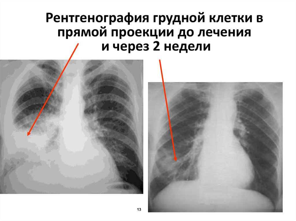 Флюорография 2. Флюорография (рентгенография) легких в 2 проекциях. Рентген ОГК В 2-Х проекциях. Флюорография ОГК В 2 проекциях. Флюорография грудной клетки в 2-х проекциях.