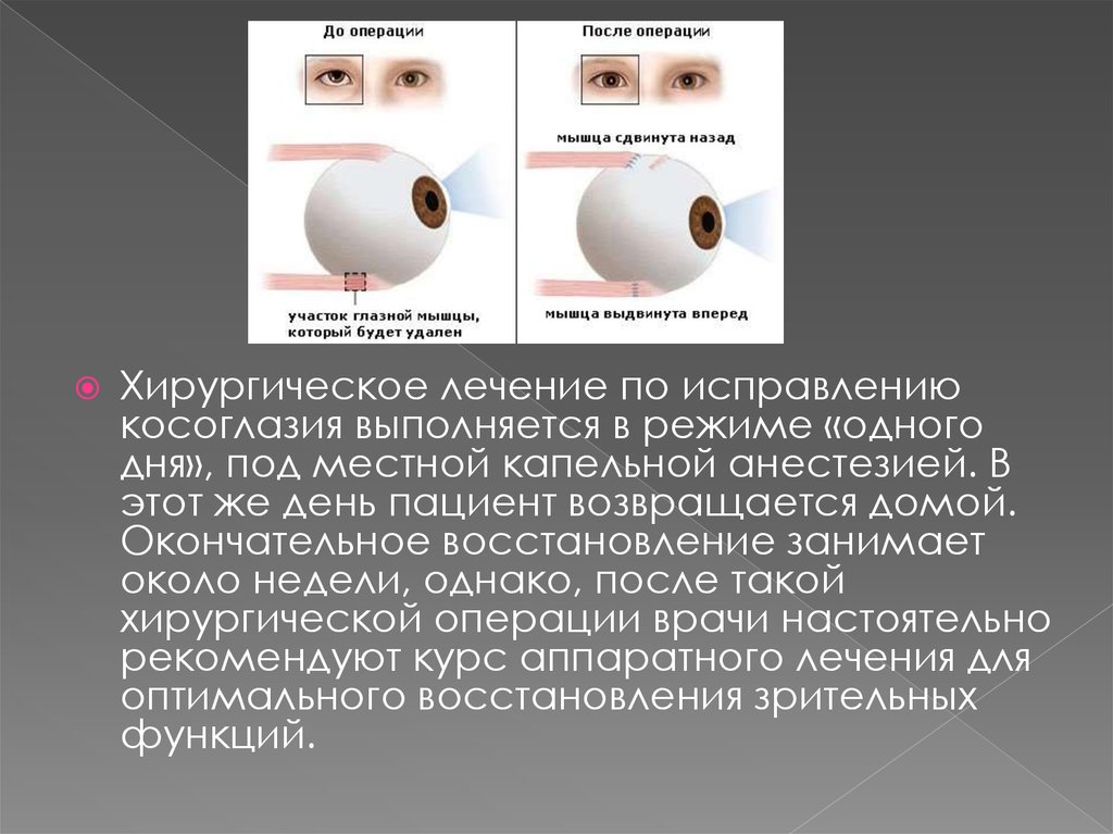 Хирургическое лечение косоглазия презентация