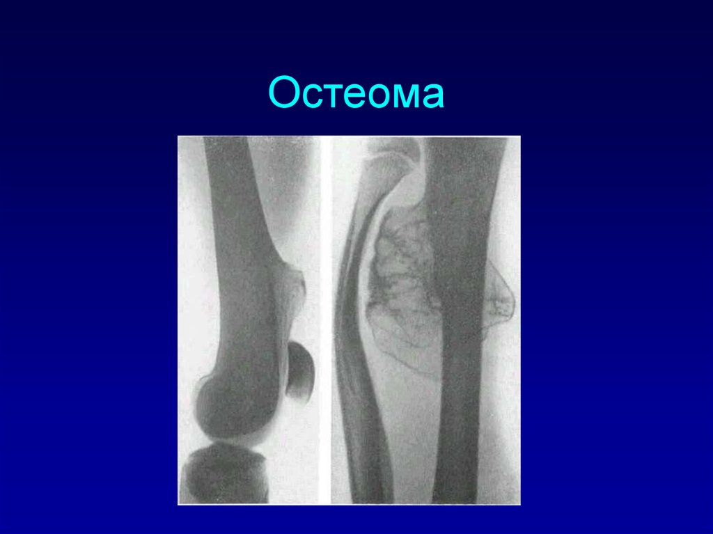 Остеома. Опухоли большеберцовой кости остеома. Губчатая остеома бедренной кости. Компактная остеома бедренной кости.