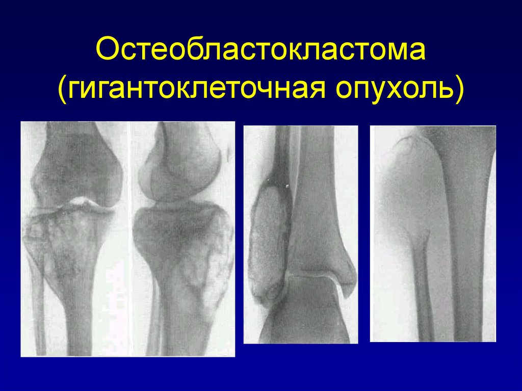 Для рентгенологической картины ячеистой формы гигантоклеточной опухоли характерно