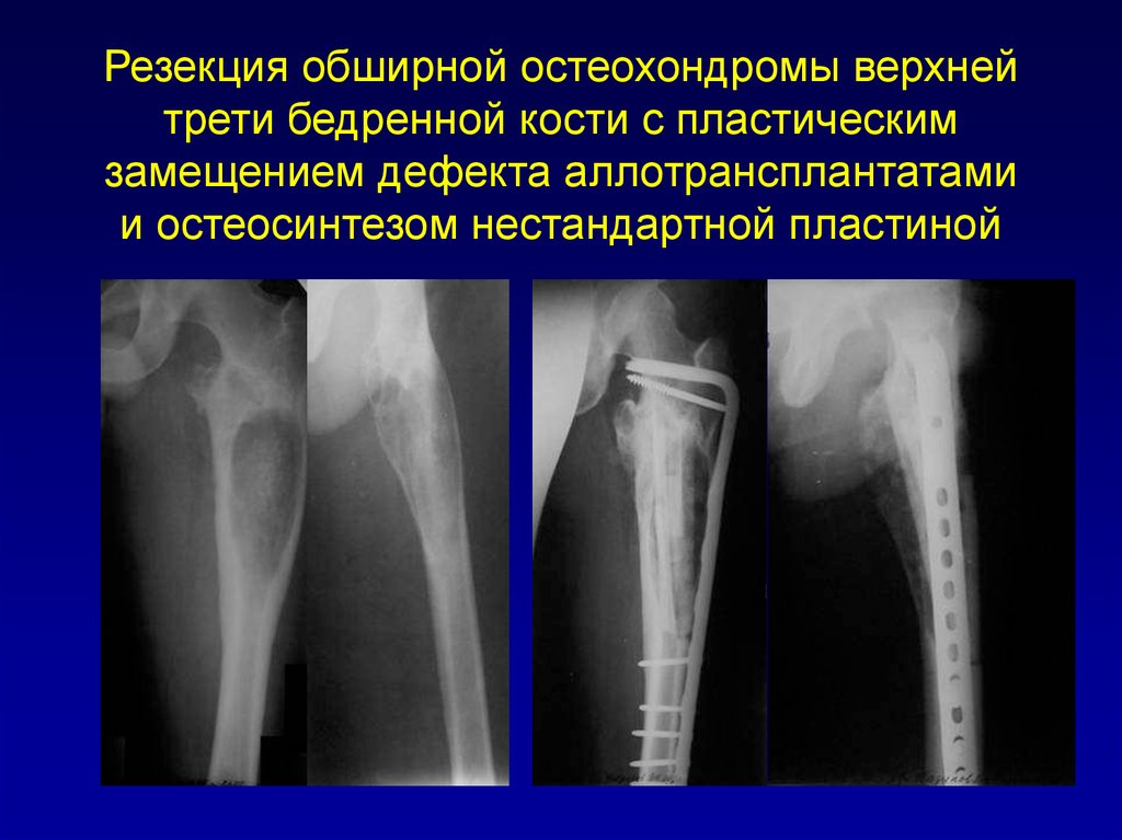 Нижняя треть бедренной кости