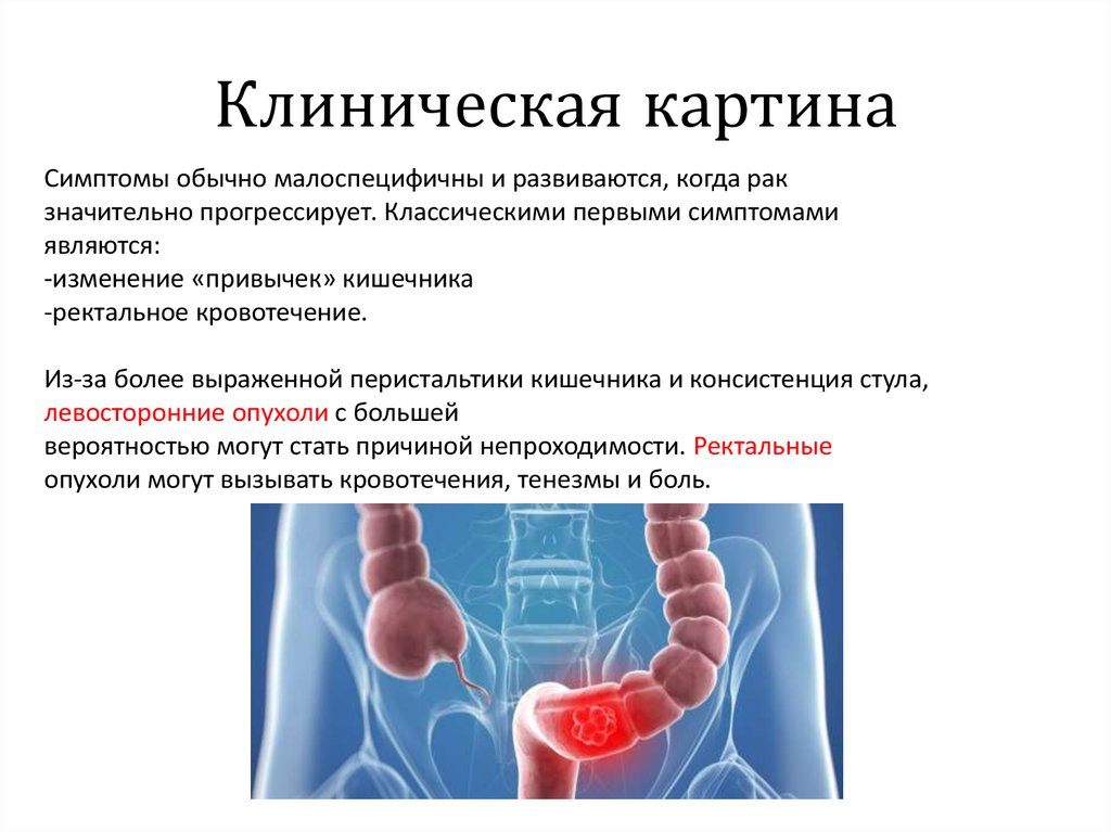 Ректальный рак симптомы