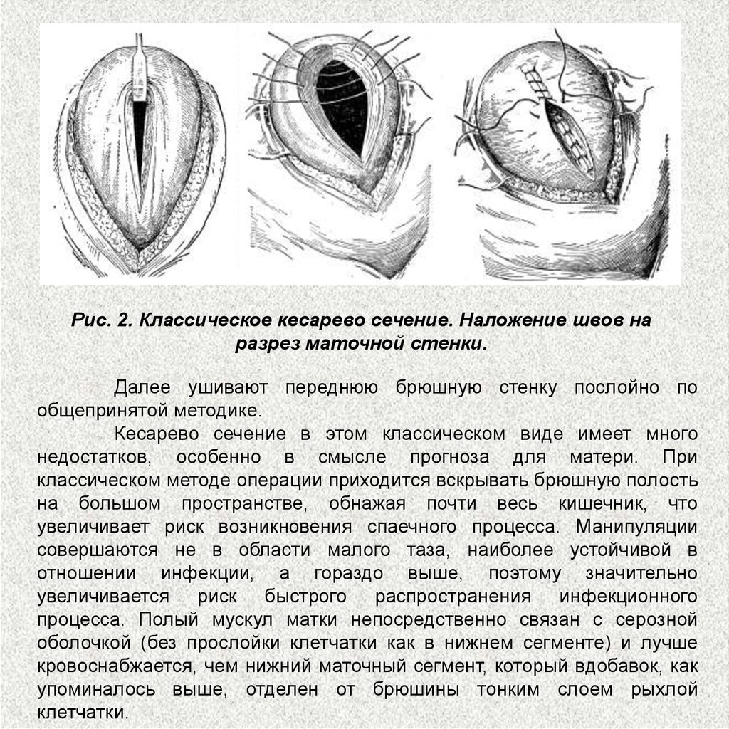 Кесарево сечение фото операции
