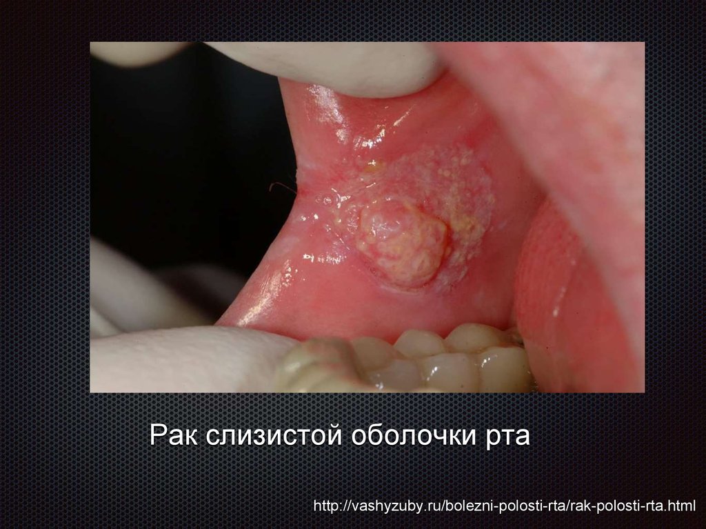 Плоскоклеточный Рак Языка Фото Плоскоклеточный Рак Языка Фото