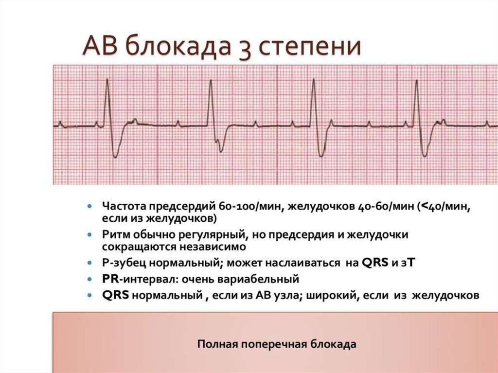 Ав блокада карта вызова