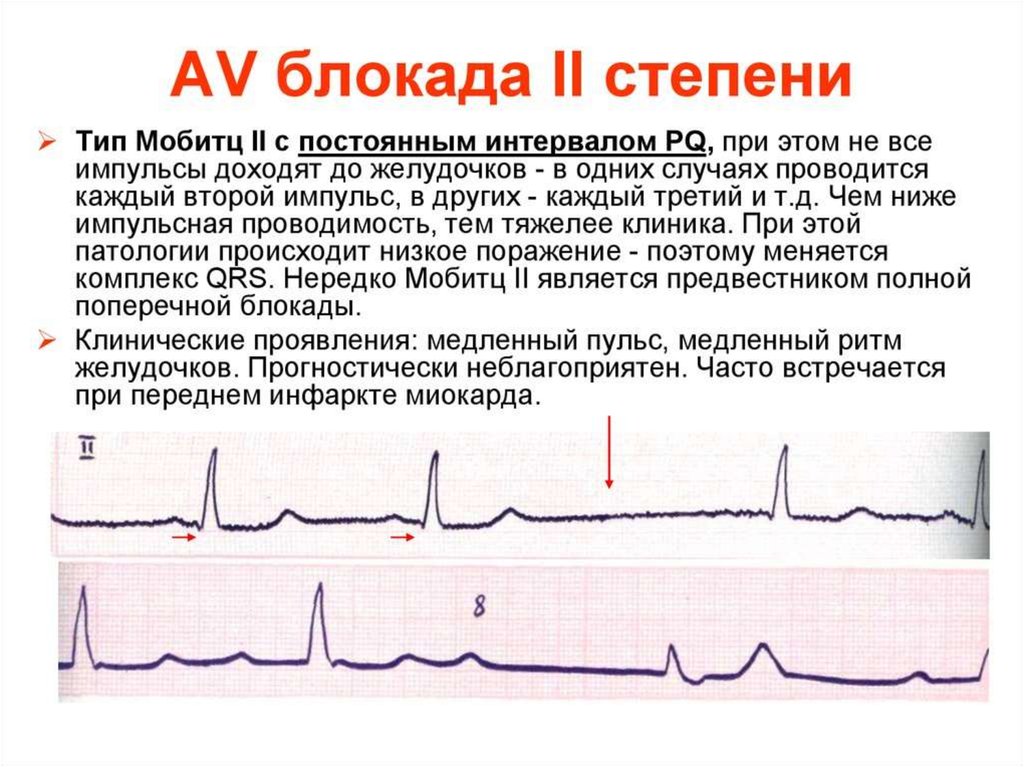 Ав блокада степени. АВ блокада 2 степени Мобитц 2 на ЭКГ. Атриовентрикулярная блокада 2 степени Мобитц 2 на ЭКГ. АВ блокада 2 степени Мобитц 1 на ЭКГ. Аб блокада 2 степени Мобитц 1 на ЭКГ.