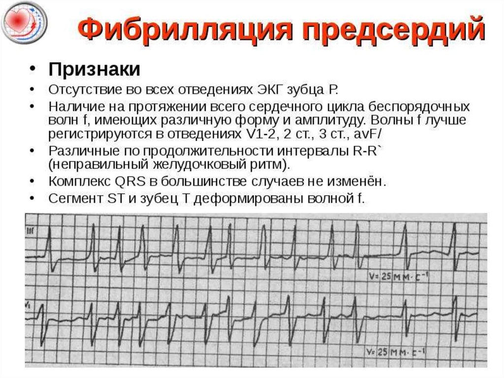 Ибс брадикардия карта вызова