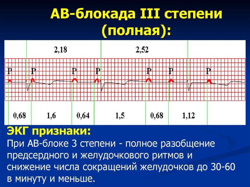 Ав блокада карта вызова