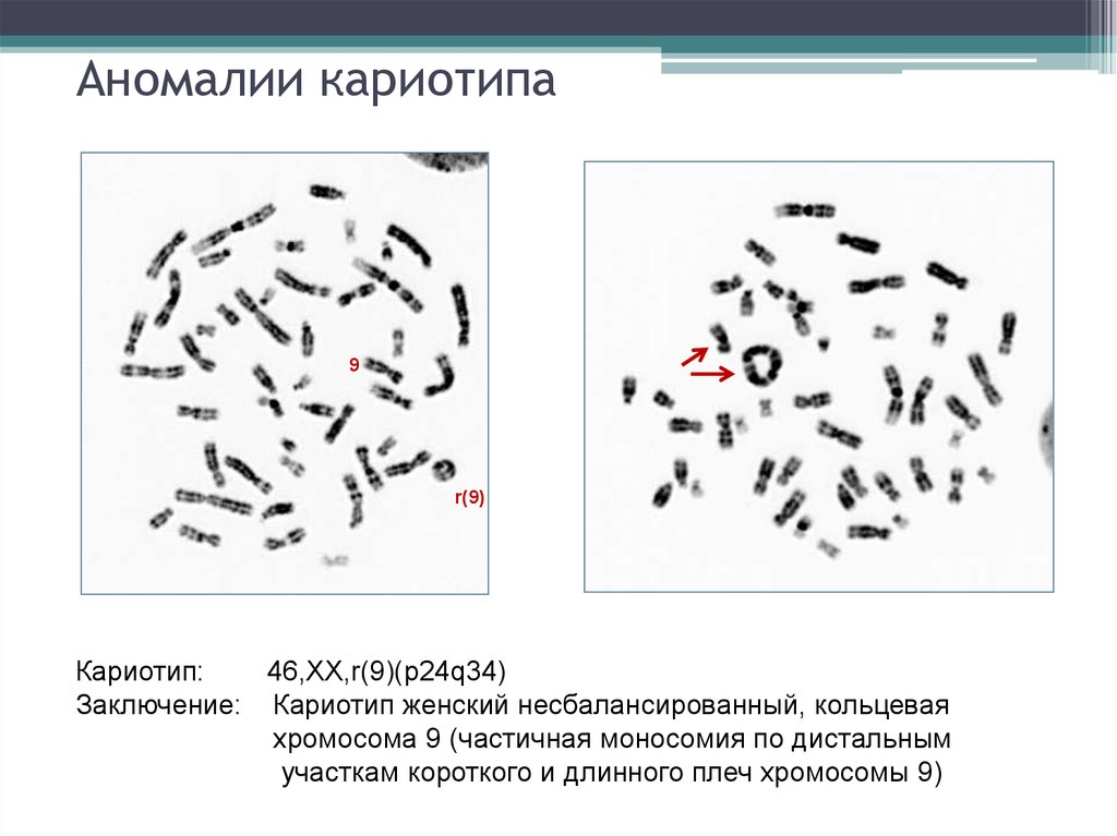 Кольцевая 4 хромосома. Аномалии кариотипа. Альбинизм кариотип. Кольцевая хромосома в кариотипе. Аномальный кариотип расшифровка.
