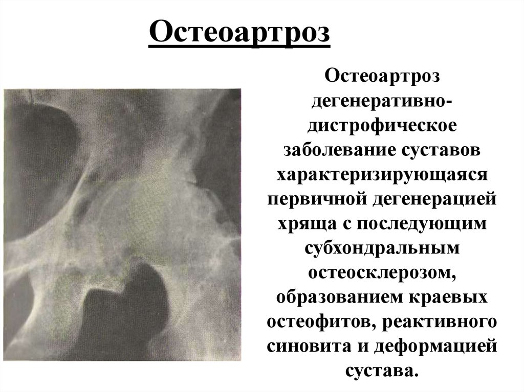 Субхондральный остеосклероз. Дегенеративно-дистрофические заболевания суставов. Дистрофические заболевания костей. Остеосклероз височной кости.