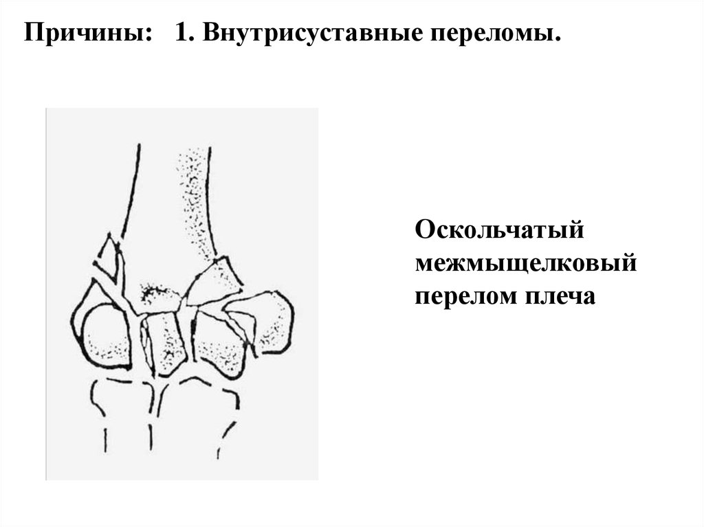 Оскольчатый внутрисуставной перелом