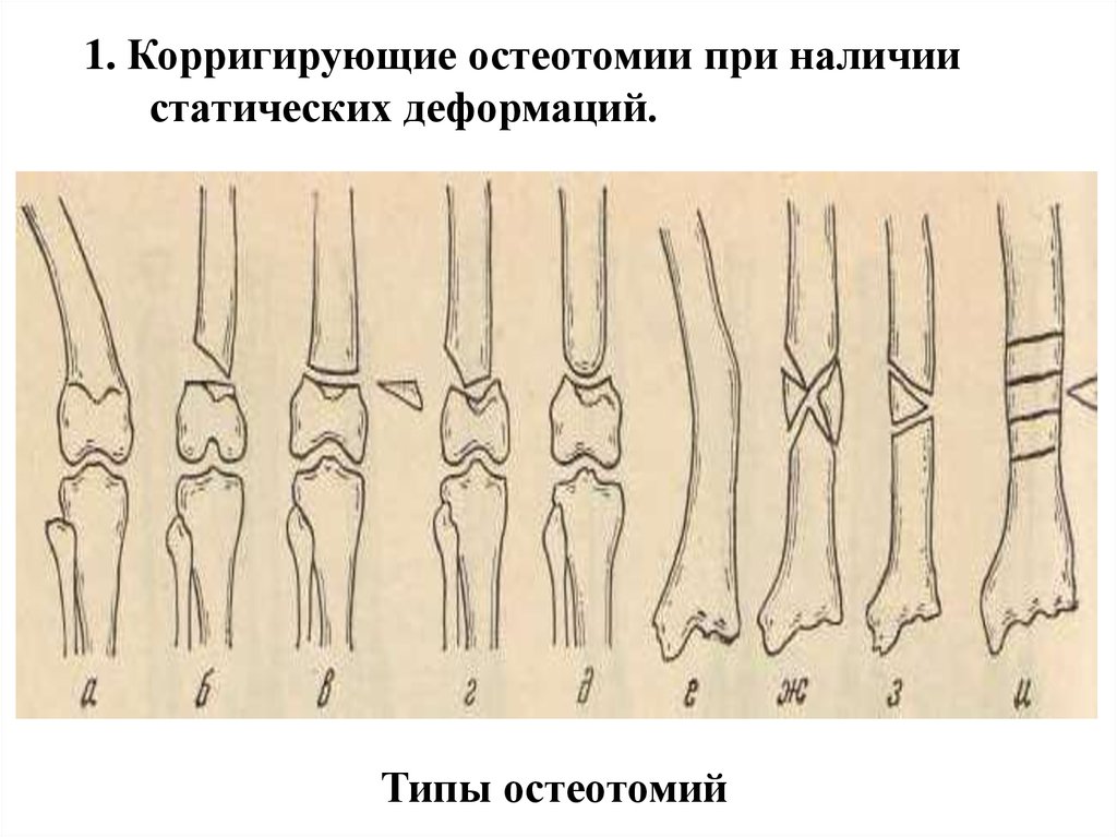 После остеотомии коленного сустава