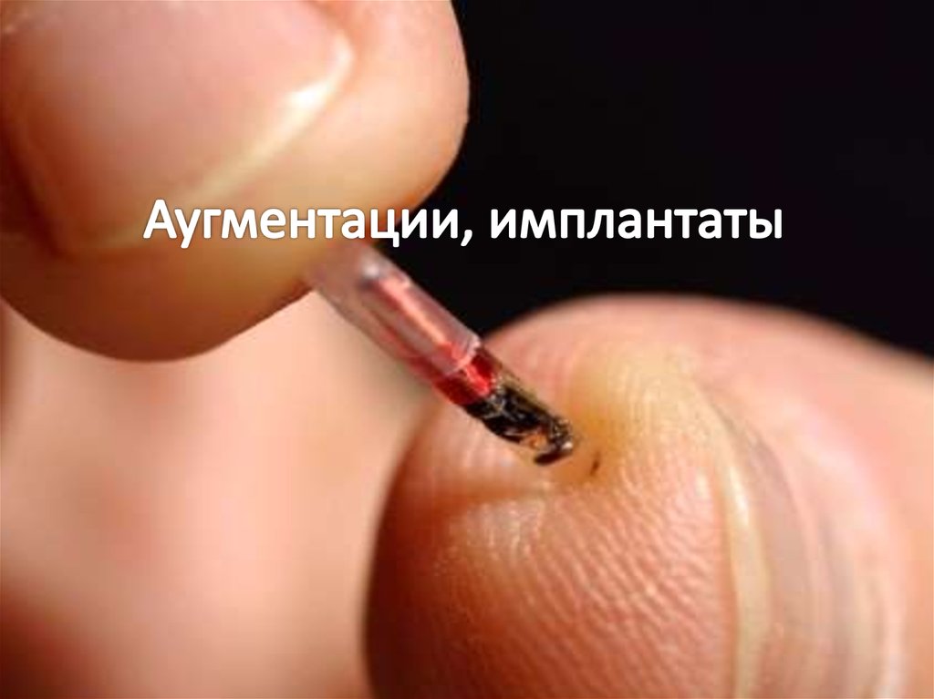 Аугментации, имплантаты
