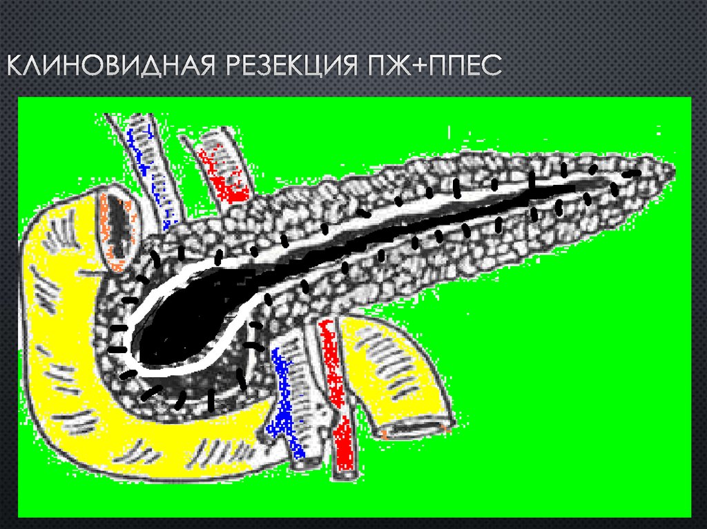 Клиновидная резекция ПЖ+ППЕС