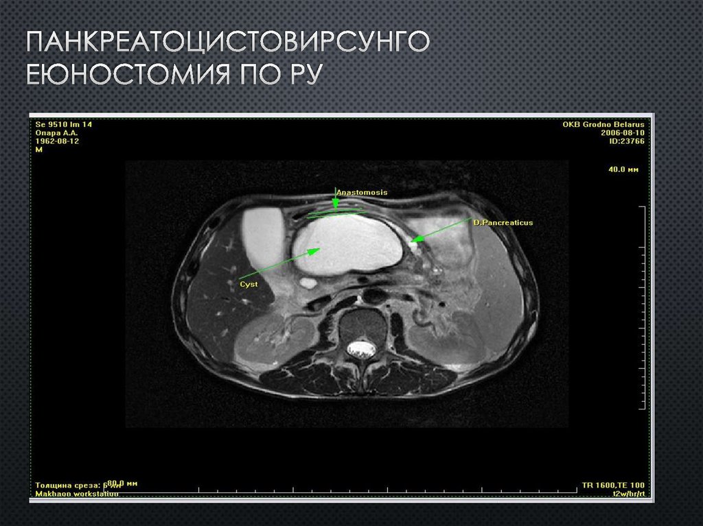 ПАНКРЕАТОЦИСТОВИРСУНГО ЕЮНОСТОМИЯ ПО РУ