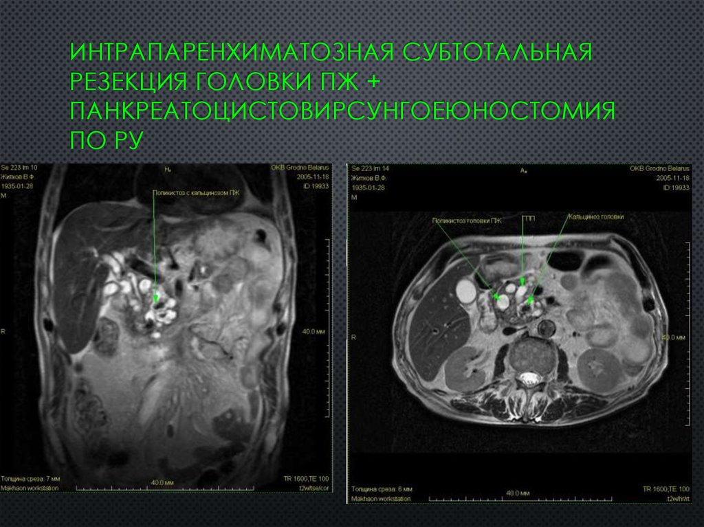 Интрапаренхиматозная субтотальная резекция головки ПЖ + панкреатоцистовирсунгоеюностомия по Ру