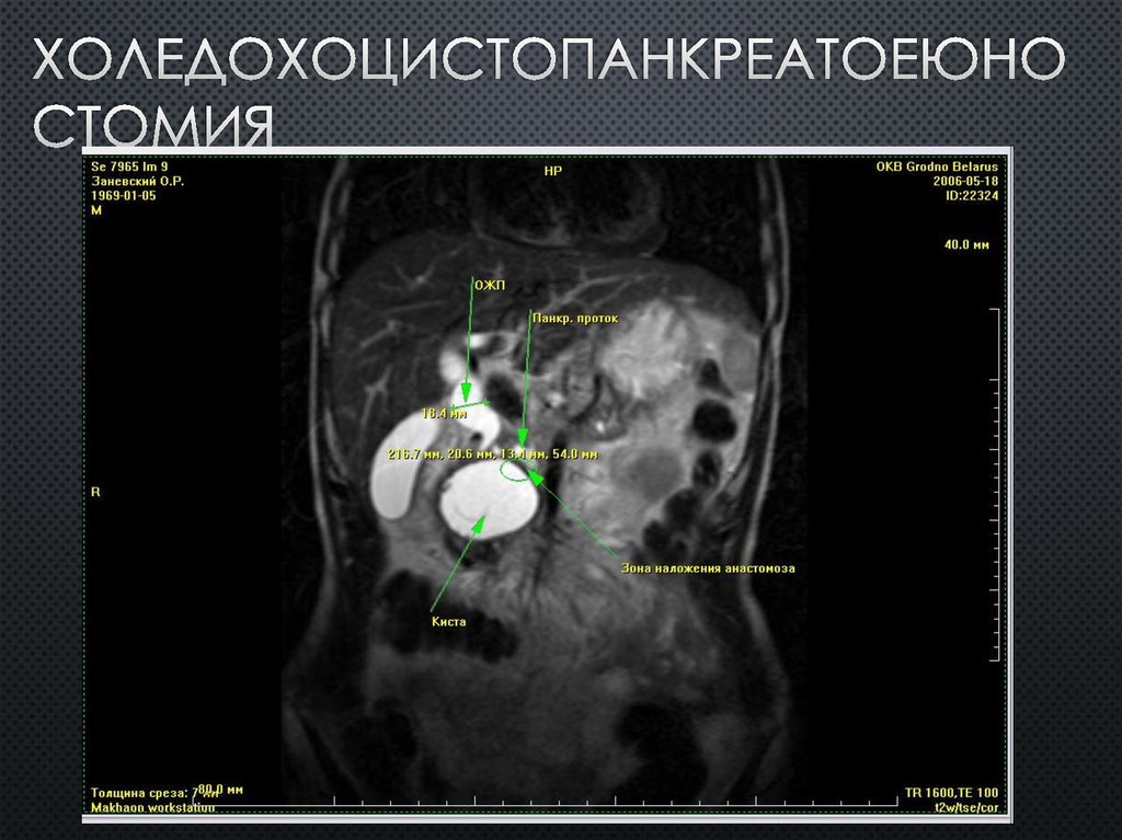 Холедохоцистопанкреатоеюностомия