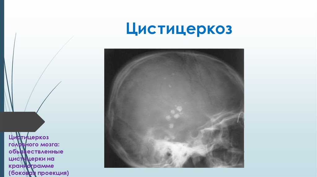 Цистицеркоз