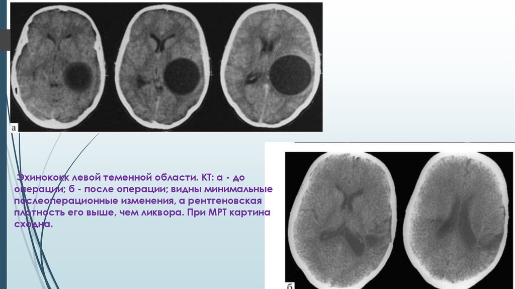 Т2 взвешенное изображение