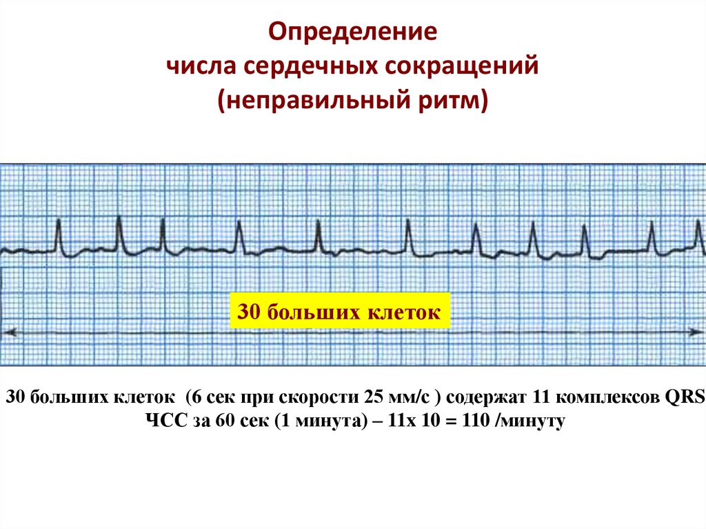 Как измерить частоту сердечных. ЧСС при неправильном ритме на ЭКГ. Мерцательная аритмия ЧСС. Как на ЭКГ посчитать частоту сердечного ритма. Подсчет ЧСС при мерцательной аритмии на ЭКГ.